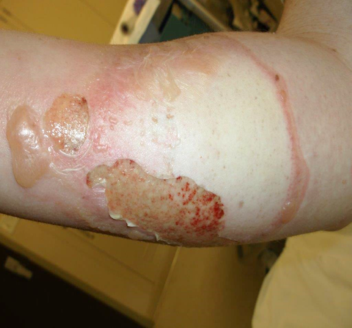 File:Full thickness burn forearm.png