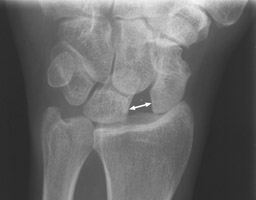 Radiolograph showing the gap between scaphoid and lunate.
