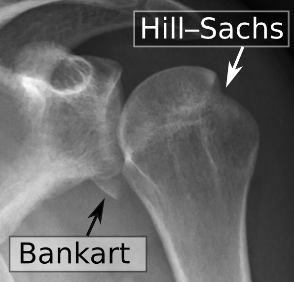 File:Shoulder dislocation, anteroposterior after reduction, with Bankart and Hill-Sachs lesions, with labels.jpeg