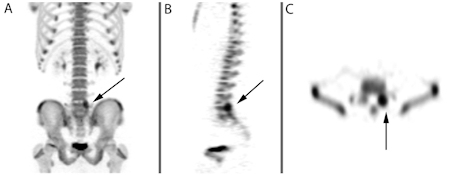 Spondylolysis SPEC image (1).docx.jpg