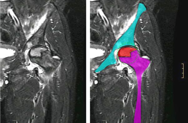 Avasculaire necrose MRI.jpg
