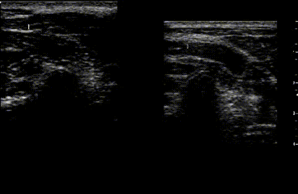 PAs with soft tissue displaced .gif