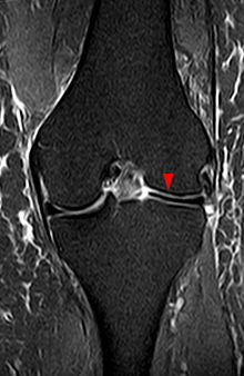 File:Discoid-meniscus-MRI.jpg