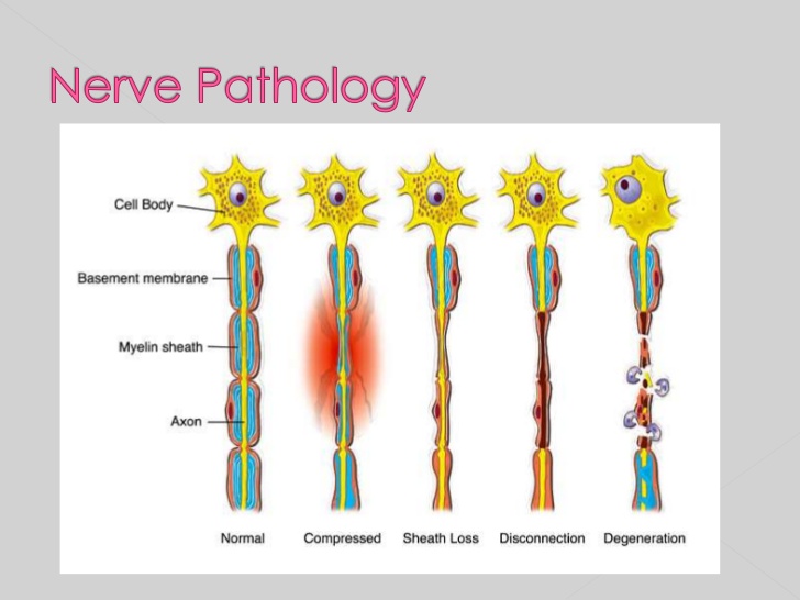 File:Nerve pathology anatomy.jpg