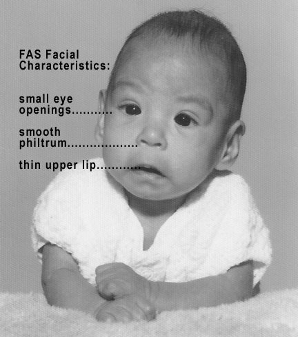 File:Photo of baby with FAS.jpeg