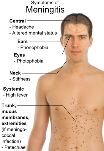 File:Symptoms of Meningitis.png