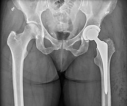 Xray of a hip which shows a left hip total arthroplasty