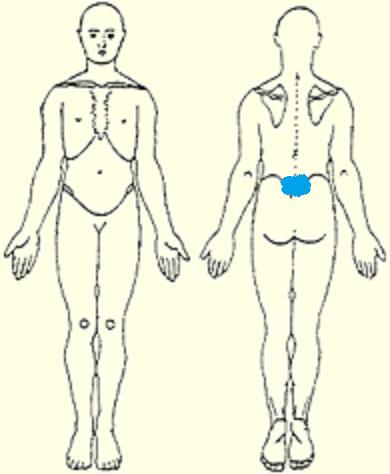 Typical body chart of a patient presenting with spondylolysis