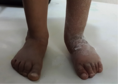 File:Case Study-Clubfoot with Post-Surgical Relapse.png