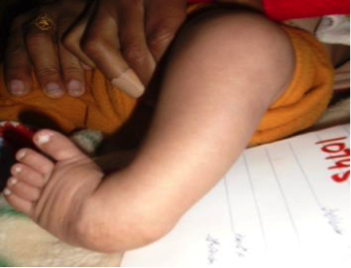 File:Case Study- Idiopathic Unilateral Clubfoot 1.png