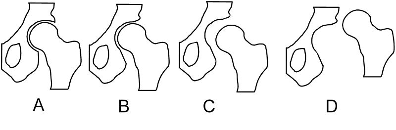 File:Hip dysplasia schematic.jpg