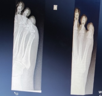 File:Toe fracture.jpg
