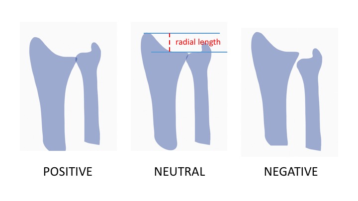 File:Radial length and ulnar variance.jpeg