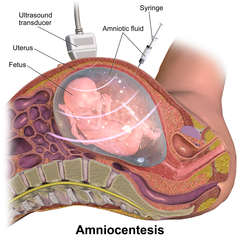 Amniocentesis.png