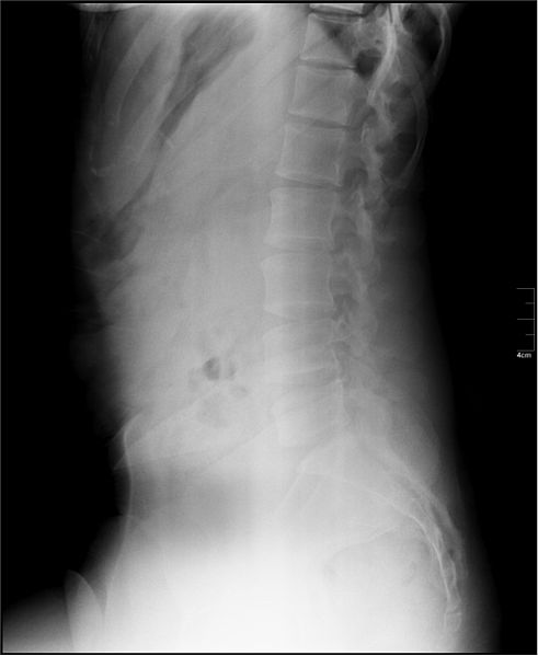 File:Lumbar x-ray decreased lordosis.jpg