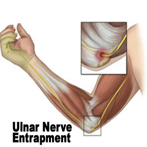 Ulnar-nerve-entrapment.jpg