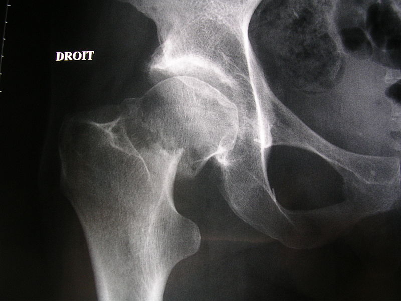 File:Neck of femur fracture (garden IV).jpeg