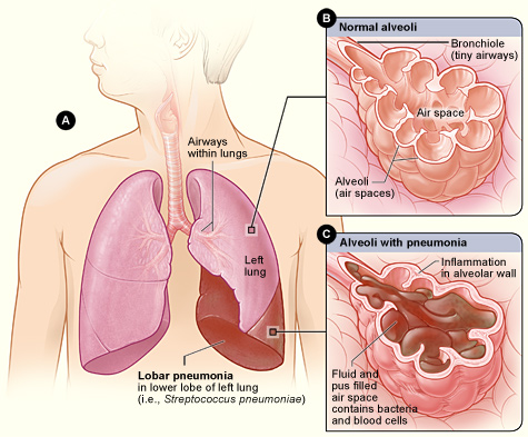 File:Pneumonia Inflammation.jpg