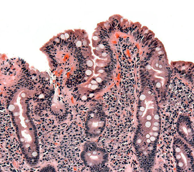File:Coeliac pathology.jpg