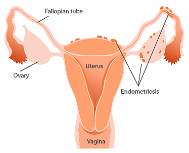 File:Endometriosis.gif