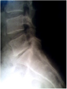 Figure: Lumbar spondylosis (from: http://en.wikipedia.org/wiki/Spondylosis)