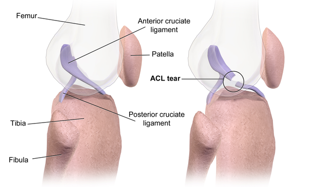 File:ACL rupture.png