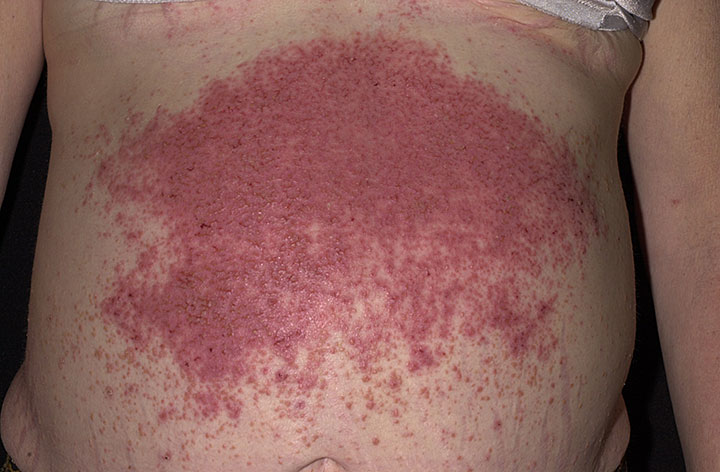File:Dermatitis herpetiformis.jpg