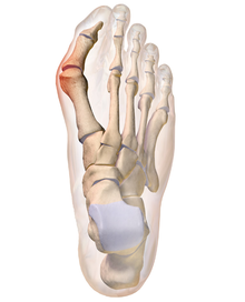 File:Bunion 2.png