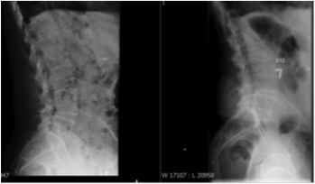 File:Radiograph of the lumbar spine.jpg