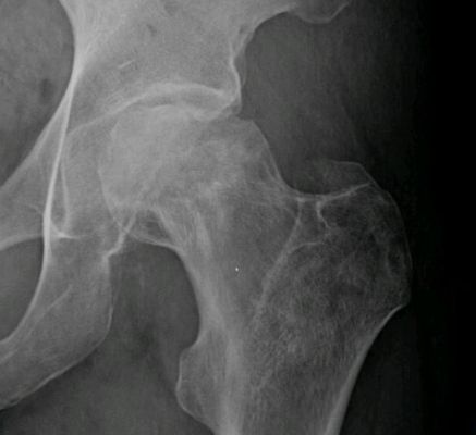 Hip X ray avascular necrosis.jpg