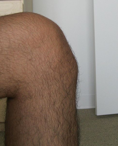 File:Male-With-Osgood-Schlatter.jpg