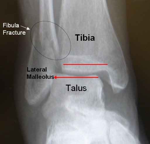 File:Fibula Fracture.jpg