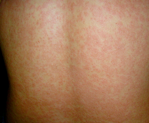 Maculopapular-rash-photo-300x247.png
