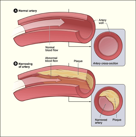 File:Atherosclerosis diagram.png