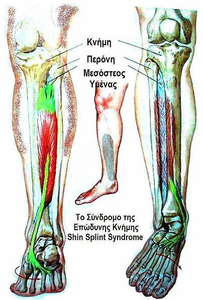 File:Shin Splint Syndrome.jpg