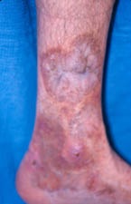 File:PAN ankle and leg.jpg