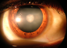 File:Cataract in human eye.png