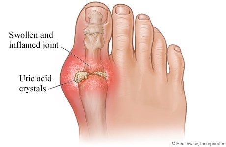 File:Gout foot.jpg