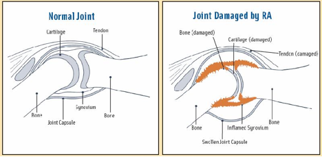 File:RA joint damage.png