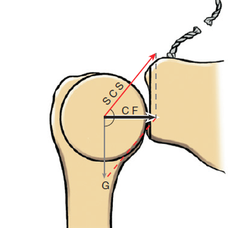 File:Glenohumeral instability.png