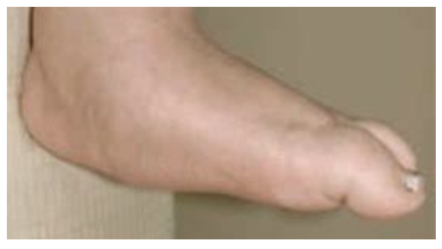 File:Charcot foot, provided by Diane Merwarth PT.png