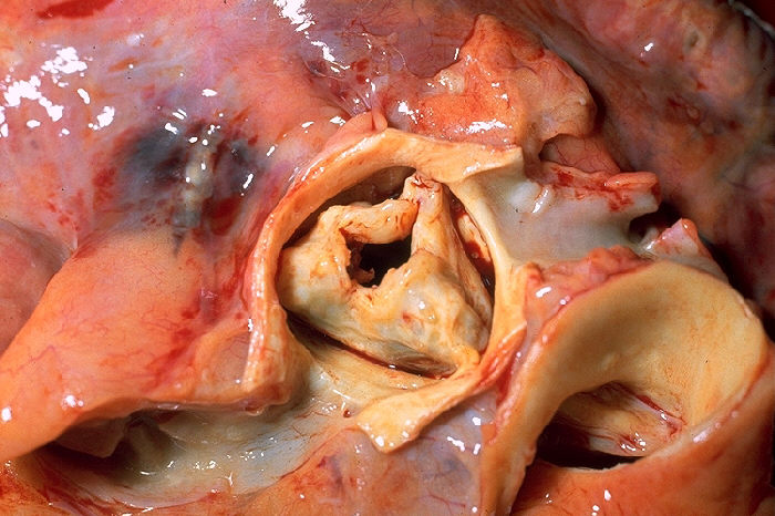 File:PP Aortic stenosis.jpg