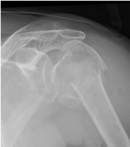 File:X-ray of fracture of proximal humerus.jpeg