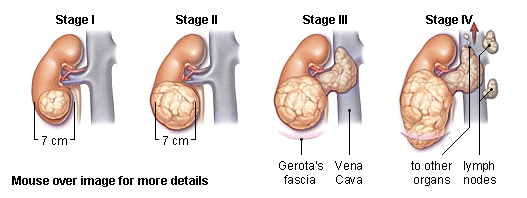 Kidney cancer stage.gif
