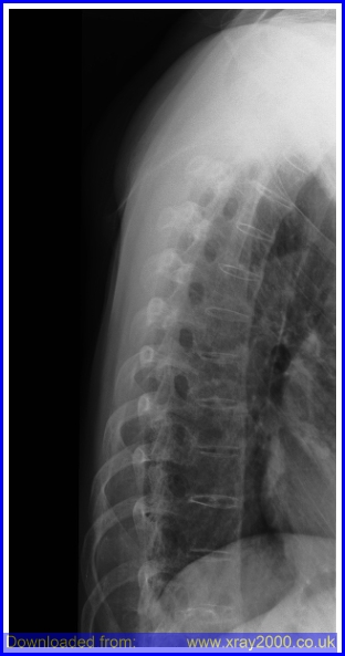 File:Spine-t ankylosing spondylitis.jpg