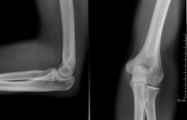 File:Elbow x-ray.PNG