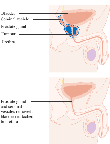 prostate surgery side effects impotence
