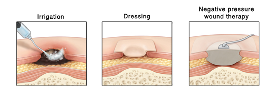 File:Dressing ulcer.jpg