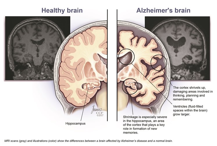 File:Alzheimers brain.jpg