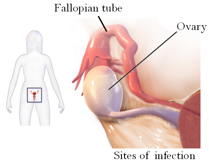 File:Sites of tubo ovarian abscess (1).png